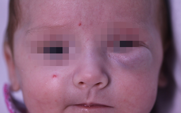 Emangioma Infantile profondo