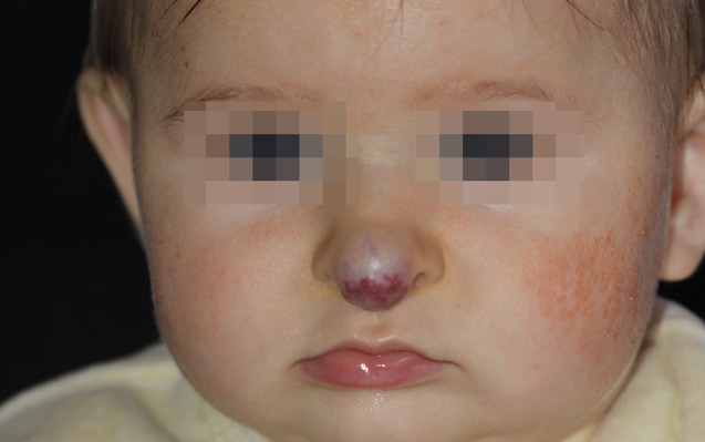 Emangioma Infantile misto
