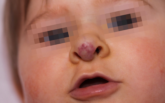 Emangioma Infantile misto