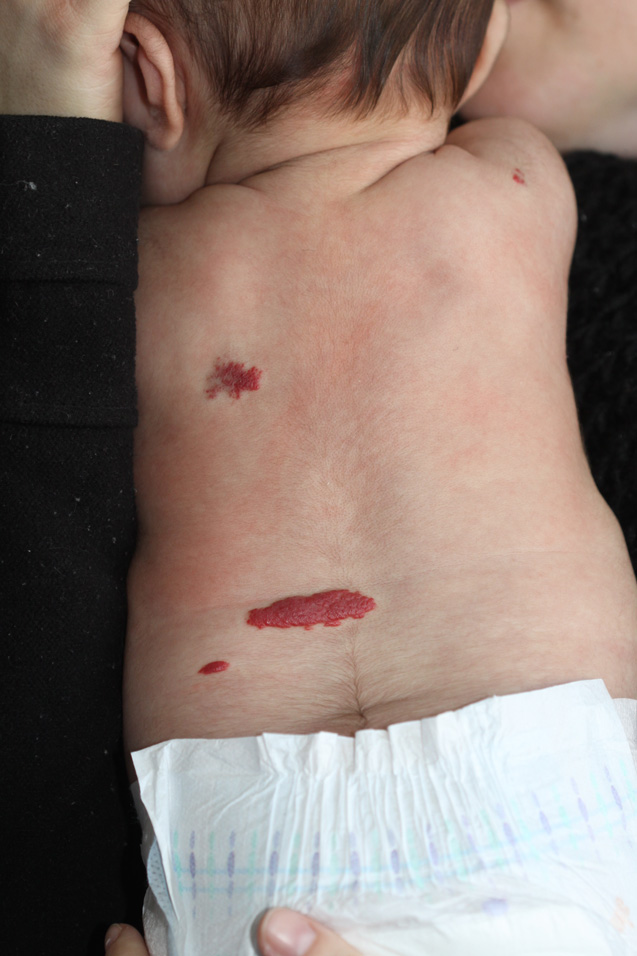Emangioma Infantile multifocale