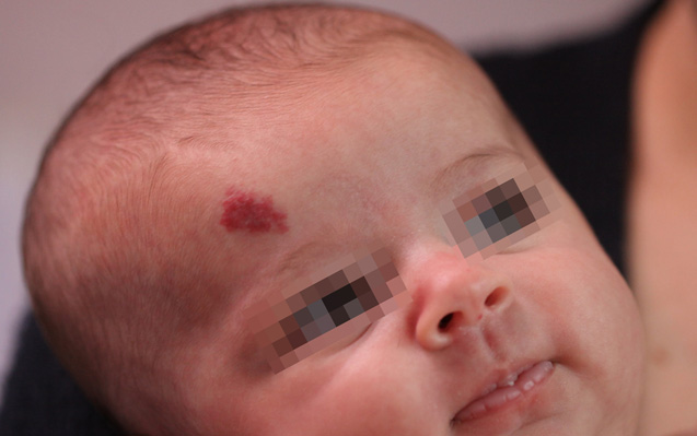 Emangioma iniziale
