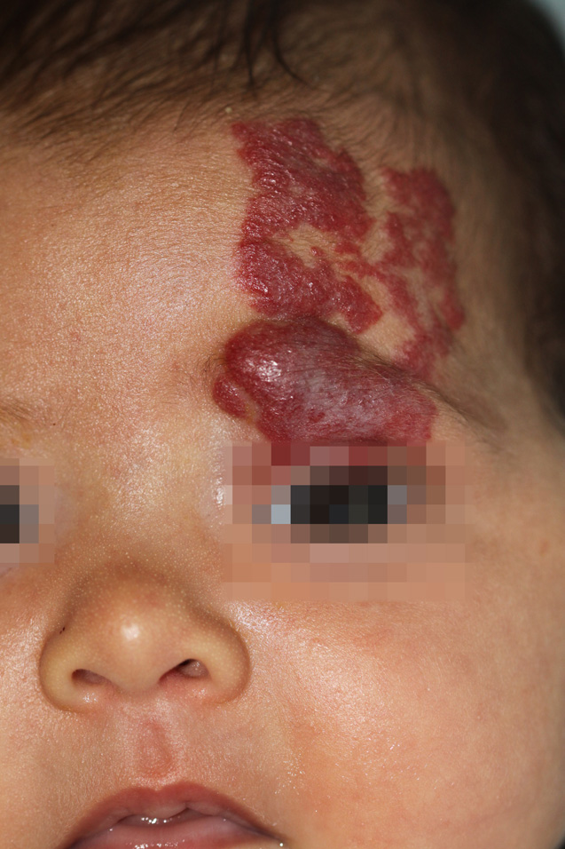 Emangioma Infantile segmentale
