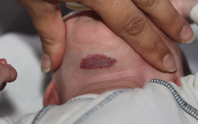 Emangioma Infantile superficiale
