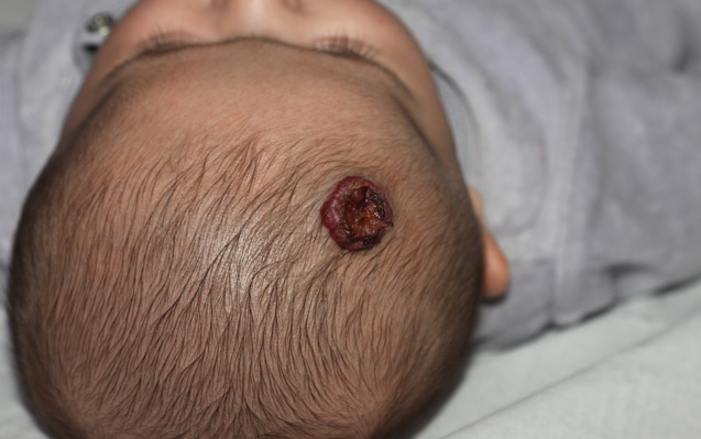 Emangioma Infantile superficiale