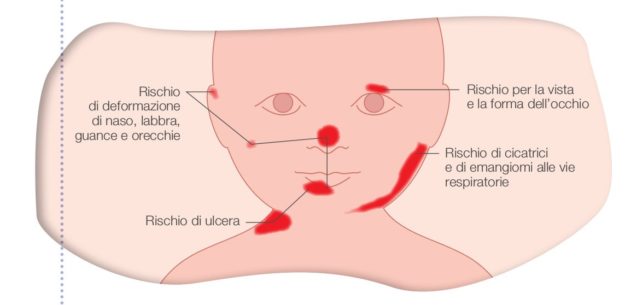 Guida per genitori di bambini con Emangioma Infantile