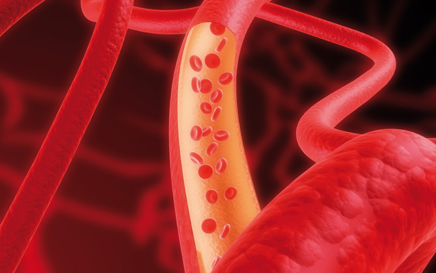 Emangioma Infantile superficiale