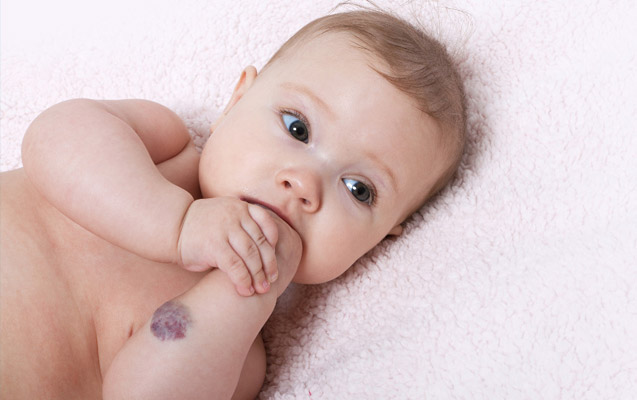  Cos’è l’angioma cutaneo o della pelle. Cause, diagnosi, trattamento 