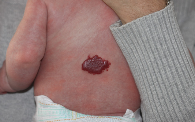 Diagnosi e trattamento di un Emangioma Infantile 