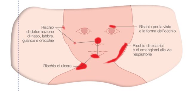 <span>Guida per genitori</span> di bambini con Emangioma Infantile